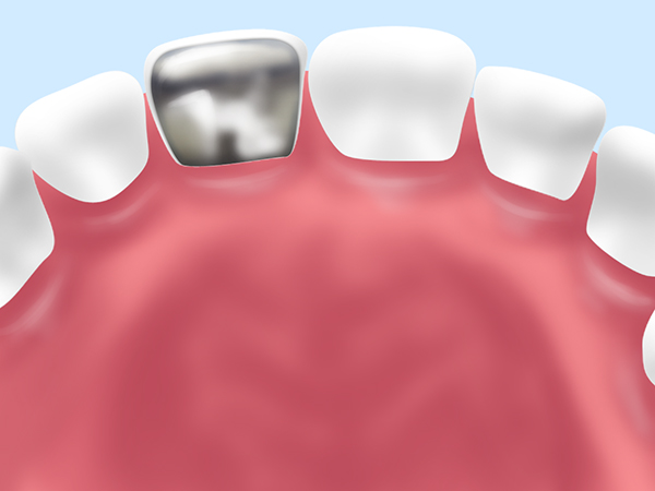 硬質レジン前装冠