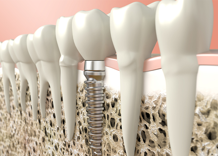 インプラント治療とは