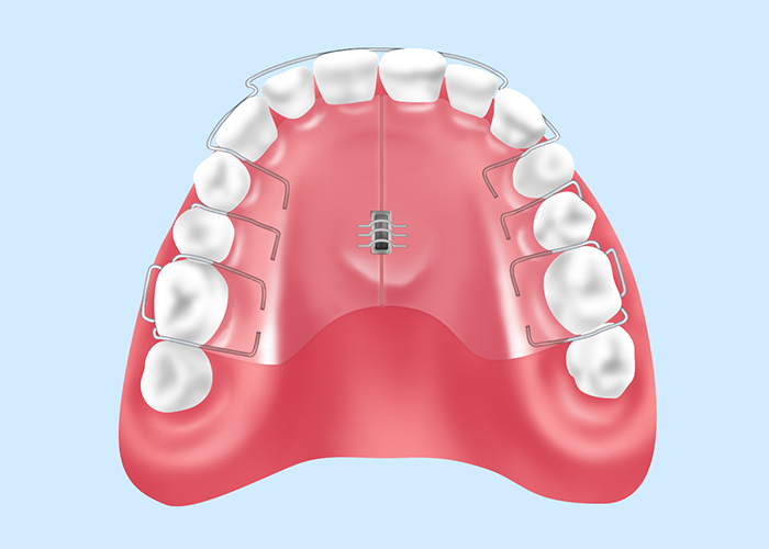お子様の負担を抑えた矯正治療