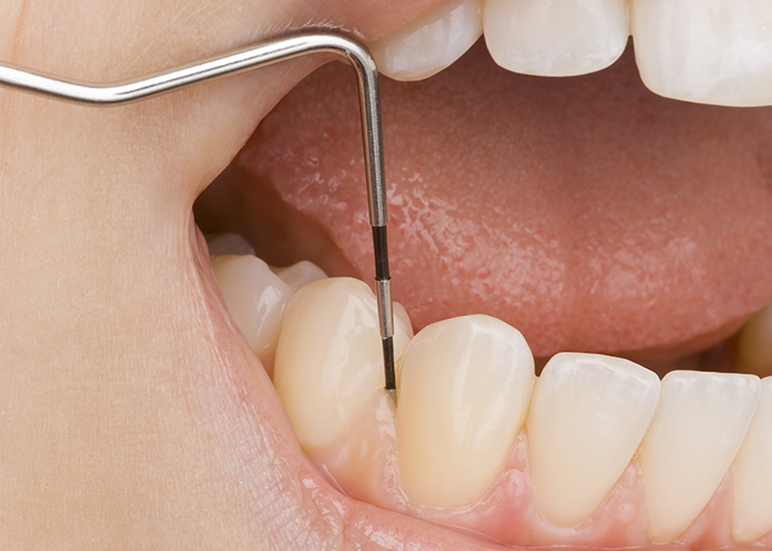 歯の寿命を左右する病気「歯周病」