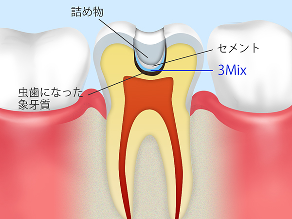 当院の取り組み～3Mix法～